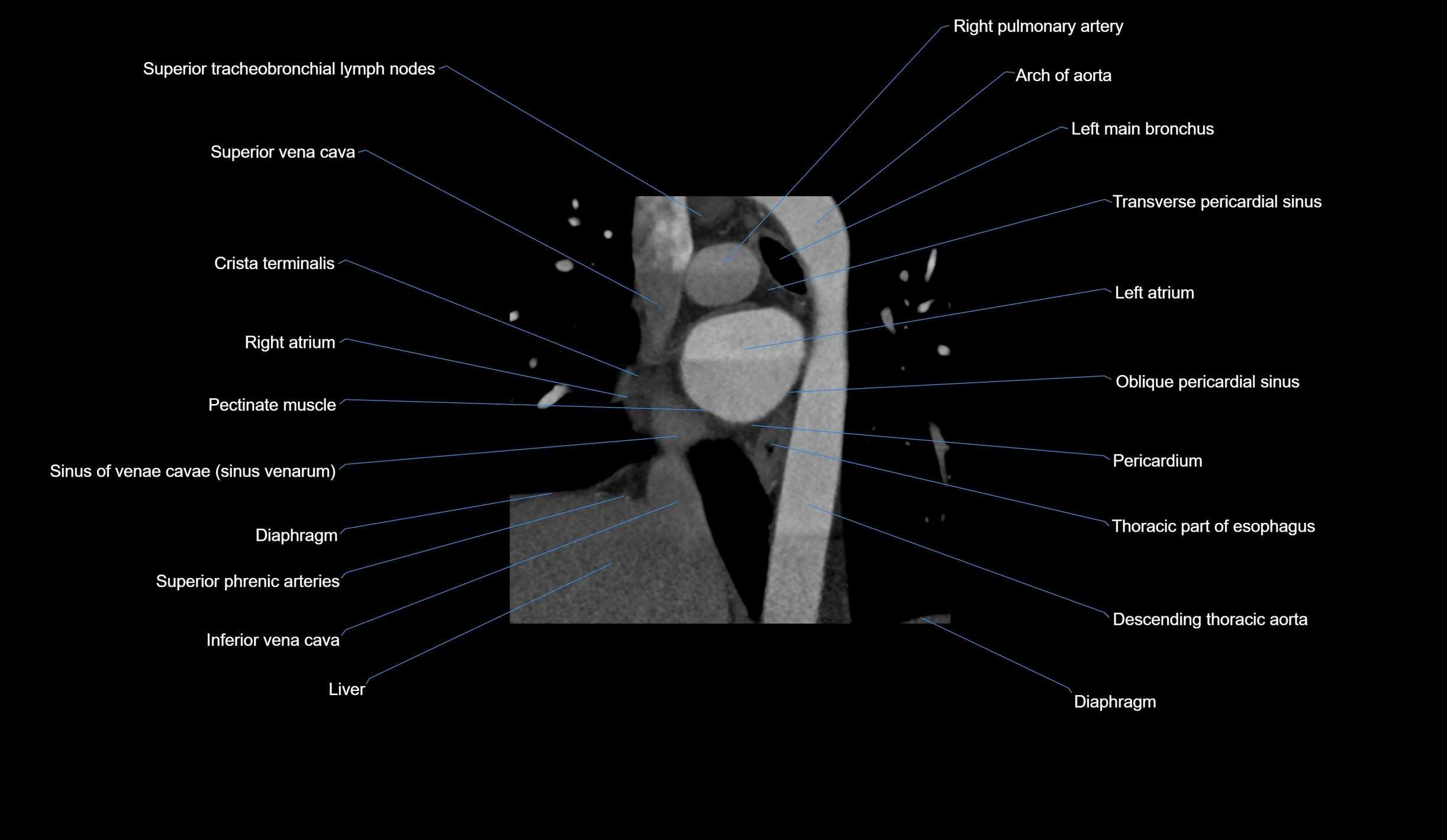 CT heart (coronary angiogram) short axis view  cross sectional anatomy labelled radiology image-00010.webp